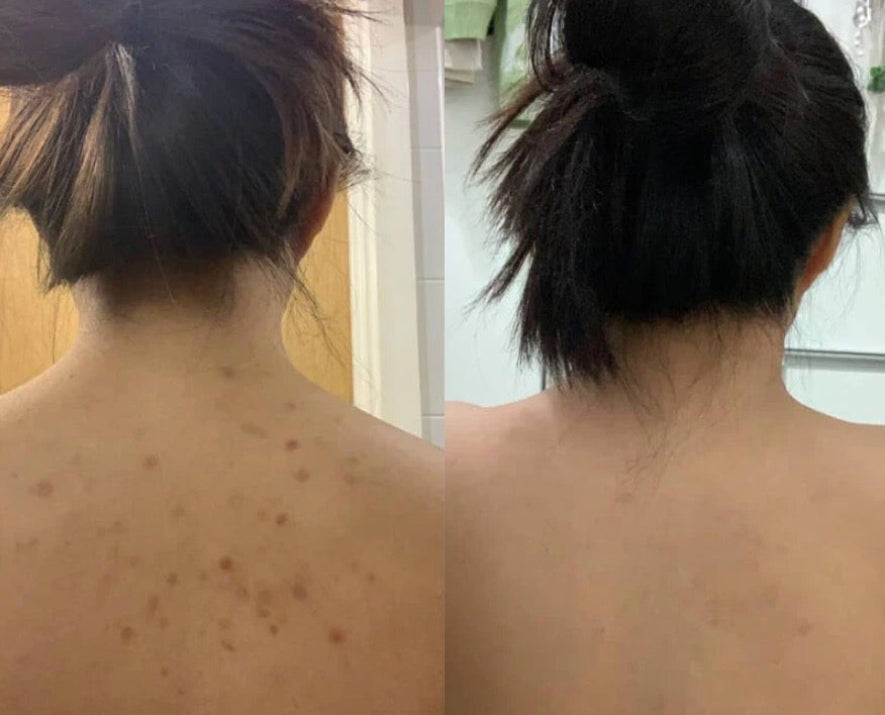 A side-by-side before and after comparison of a woman's back, showing acne breakouts on the left and clearer skin on the right.