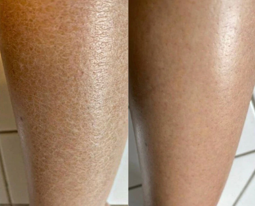 Before and after comparison of a human leg showing a reduction in dry, cracked skin texture.